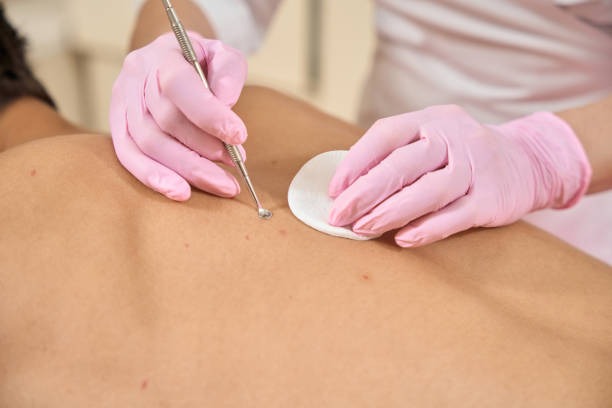 Back Acne Treatment: Effective Ways to Manage and Prevent Breakouts